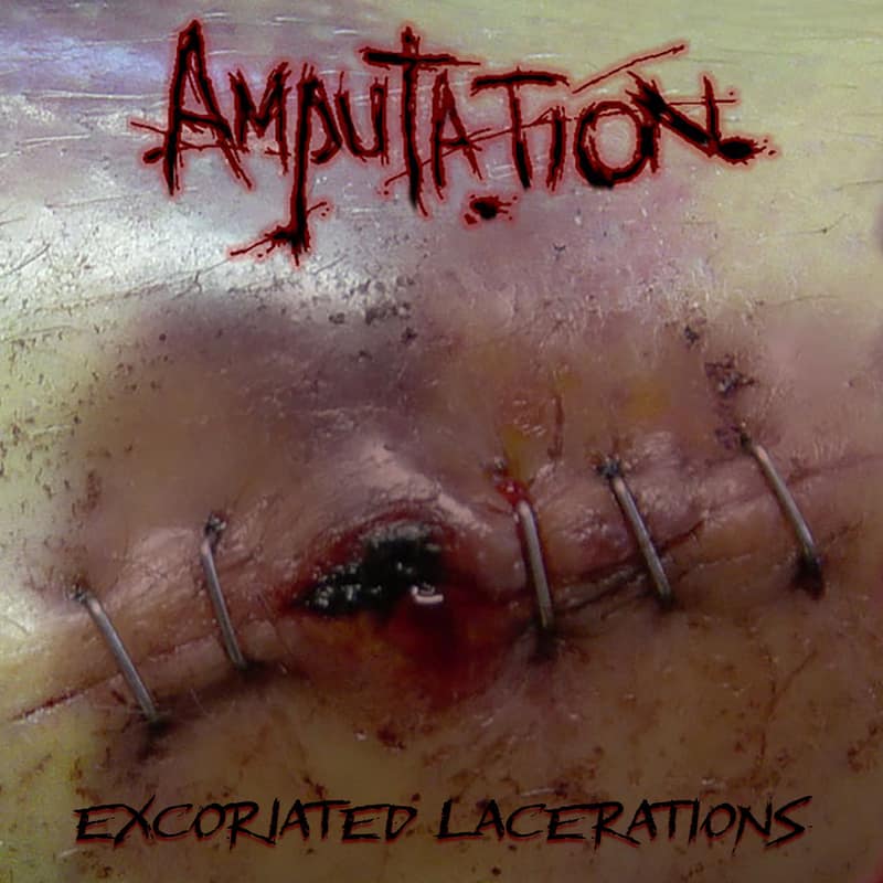 Amputation